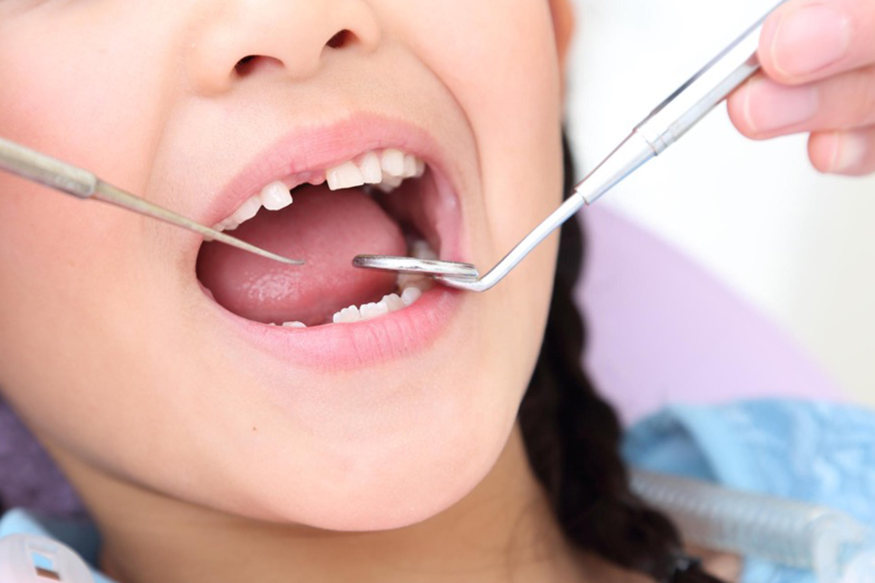 お子さんのむし歯治療と予防